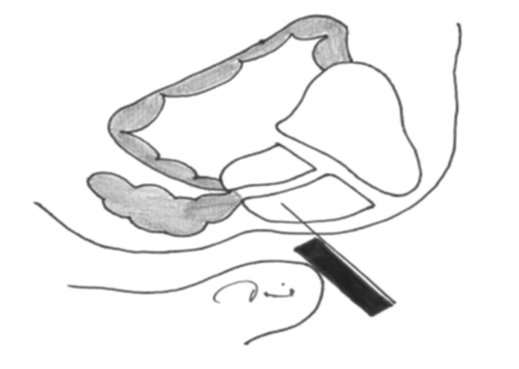 Figura 2. Esquema de realización de biopsia de próstata TR.