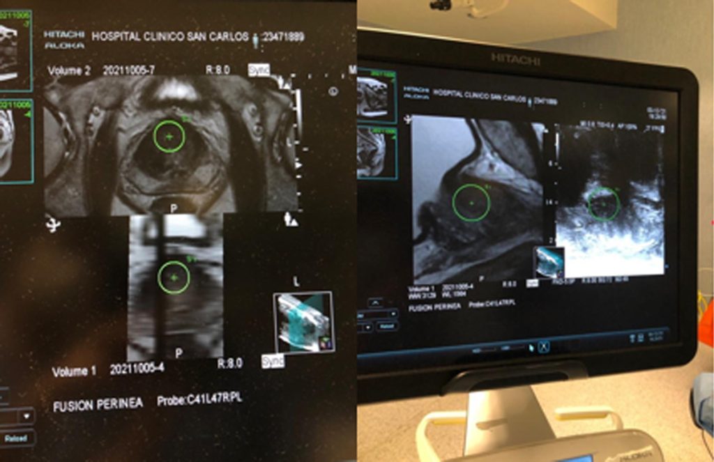 Figura 7. Fusión de planos de RMN previo a iniciar la biopsia. A la derecha, fusión de imagen de RMN con la ecografía en tiempo real. En ambas imágenes, vemos la zona sospechosa de RMN a biopsiar marcada.