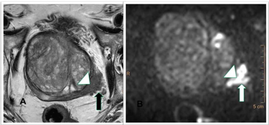 Figura 9. Corte axial en T2 (A) y corte axial en difusión (B). Tumor en la zona periférica posterolateral izquierda (cabezas de flecha). Tumor invadiendo la bandeleta neurovascular izquierda(flechas)