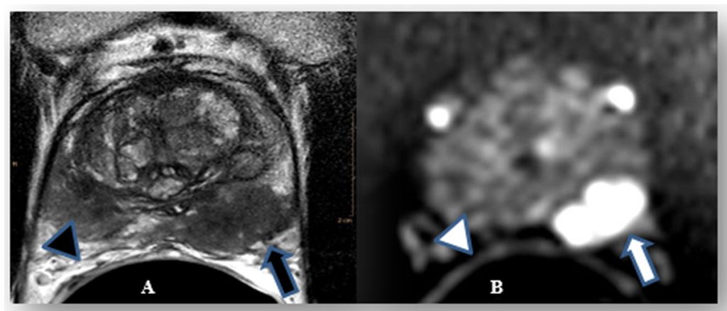 Figura 15. Corte axial en T2(A) y difusión (B). Tumor en la zona periférica izquierda con afectación extraprostática(flechas). Prostatitis en la zona periférica derecha (cabeza de flecha). Permite realizar cirugía de preservación de la bandeleta derecha [9].