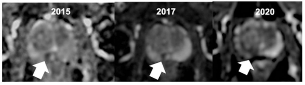 Figura 19. Secuencias potenciadas en difusión con el mapa ADC en paciente en vigilancia activa y seguimiento con RM. En los estudios de entre 2015-17, la lesión con restricción focal de la difusión situada en la zona periférica derecha (flechas) estaba estable. Tres años más tarde y coincidiendo con el aumento del PSA ha aumentado el tamaño de la lesión presentando menor ADC, lo que indica progresión radiológica que se confirma tras la biopsia con un aumento del Gleason.