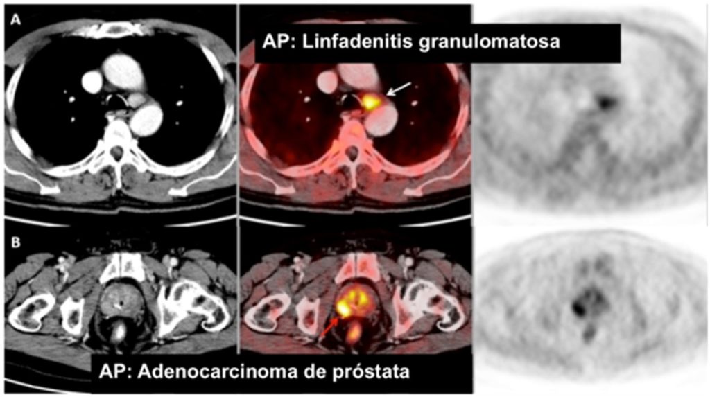 Figura 4. Paciente varón de 70 años, con adenocarcinoma de próstata Gleason 7 (4 + 3), tratado con radioterapia con intención radical. En el seguimiento clínico se evidenció una recidiva bioquímica (PSA 9,35 ng/ml). La PET-TC 18F-colina mostró captación patológica en una lesión nodular en el lóbulo prostático derecho (B, flecha roja), compatible con enfermedad maligna, con confirmación de malignidad en la pieza quirúrgica. Se identificó además captación de colina en una adenopatía mediastínica paratraqueal izquierda (A, flecha blanca). La PAAF de la adenopatía mediastínica fue compatible con linfadenitis granulomatosa.