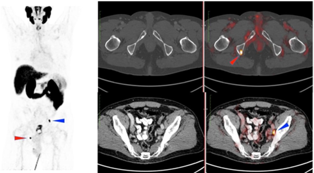 Figura 6. Paciente varón de 61 años operado de adenocarcinoma de próstata Gleason 7 (3+4), p3b pN0 M0 con PSA al diagnóstico de 11,01 ng/ml en 2016 (Prostatectomía laparoscópica asistida por robot y linfadenectomía ilioobturatriz bilateral radical) con RT posterior. PSA nadir de 0,2 ng/ml. Posterior recidiva en rama isquiopubiana derecha tratada con SBRT. Ascenso progresivo del PSA (0,41 ng/ml) con estudio de extensión negativo. El estudio PET-TC 18F-DCFPyL muestra captación patológica en isquion derecho (flecha roja) y en un ganglio en cadena iliaca izquierda de 5 mm (flecha azul), compatibles con metástasis.