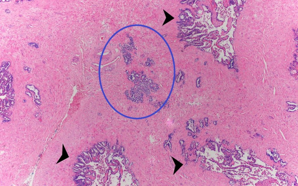 Figura 3. En esta imagen, se señala con flechas negras cortas vesículas seminales normales y en la zona central, infiltrando el estroma un foco de adenocarcinoma acinar.