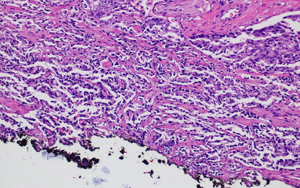Figura 4. Imagen de un foco de adenocarcinoma acinar que contacta el margen pintado con tinta negra.