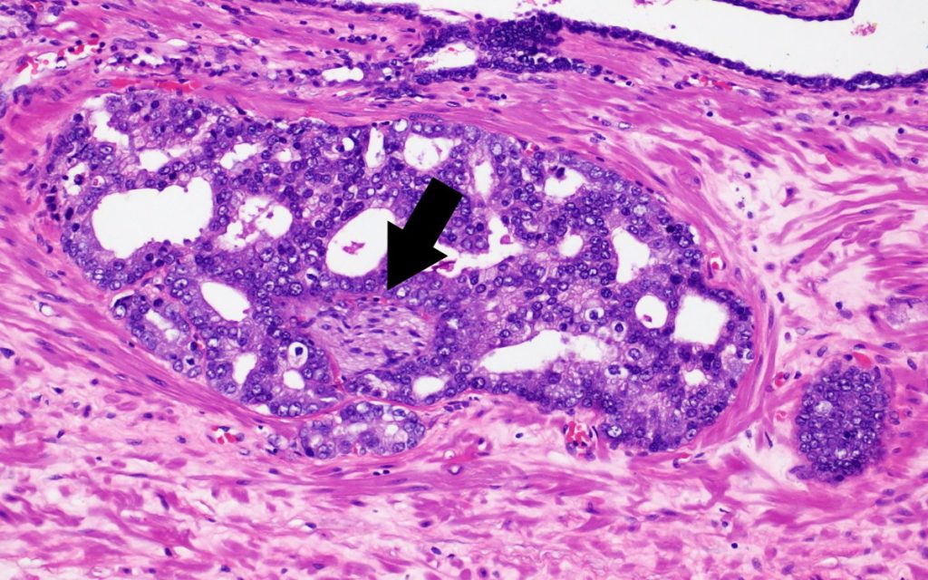 Figura 5. Se identifica una estructura neural (señalada con flecha negra) totalmente rodeada por adenocarcinoma.