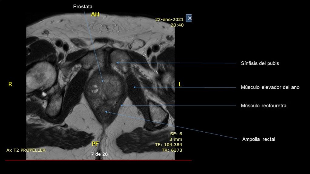 Figura 1. Relaciones anatómicas de la próstata. Corte AP de RNM prostática.