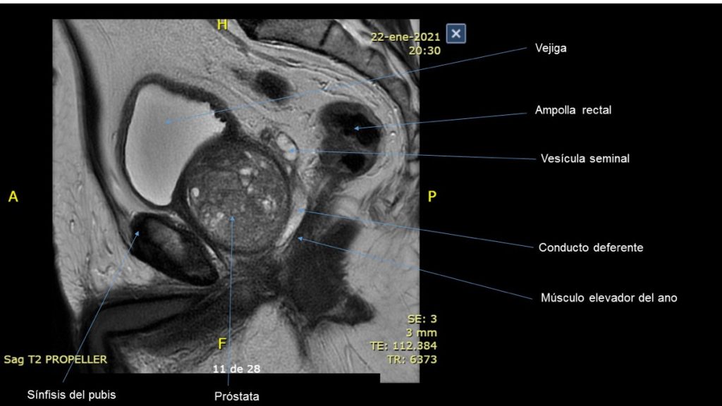 Figura 2. Relaciones anatómicas de la próstata. Corte sagital de RNM prostática.
