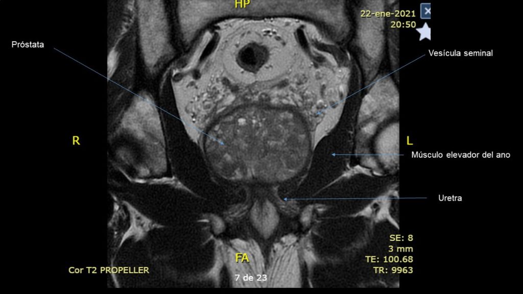 Figura 3. Relaciones anatómicas de la próstata. Corte coronal de RNM prostática.