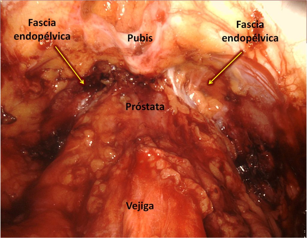 Figura 10. Visualización de ambas fascias endopélvicas cubiertas de grasa tras haber retirado la vejiga hacia cefálico.