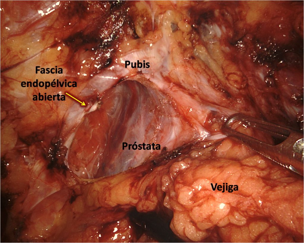 Figura 12. Fascia endopélvica izquierda abierta.