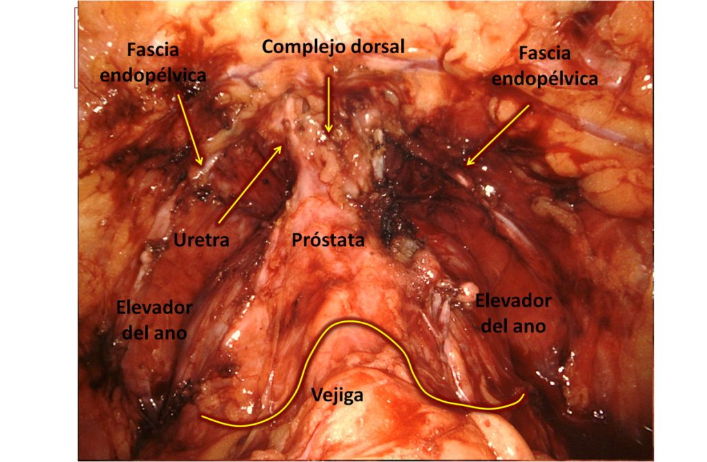 Figura 13. Visión una vez abiertas ambas fascias endopélvicas y separadas las fibras del elevador del ano, permitiendo visualizar la uretra y el complejo de la vena dorsal del pene. Se puede visualizar también el cuello de la vejiga en forma de V invertida.