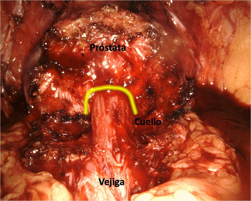 Figura 14. Visión del cuello vesical una vez disecado el mismo. Obsérvese la entrada perpendicular de las fibras del musculo detrusor en la próstata.
