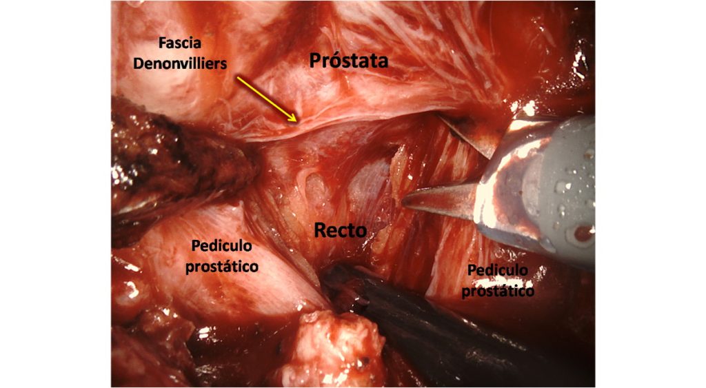 Figura 23. Incisión completa en fascia de Dennonvilliers. Se identifican a ambos lados de la próstata los pedículos prostáticos.