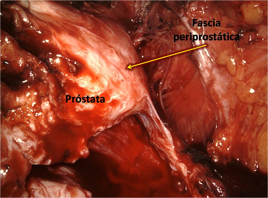 Figura 24. Fascia periprostática del lado derecho adherida a la próstata antes del inicio de la disección.