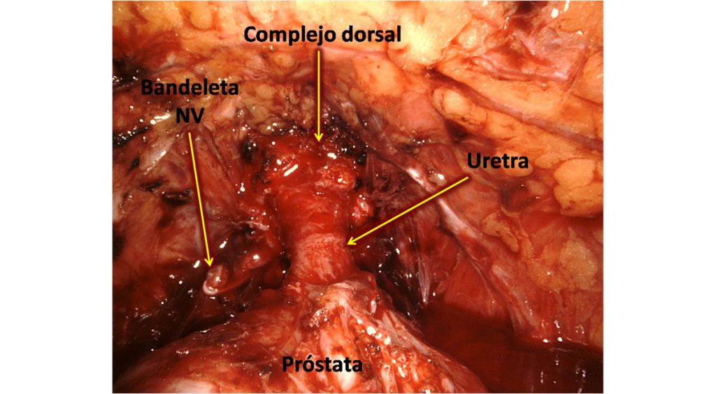 Figura 26. Puntos de referencia para la disección apical. uretra, complejo de la vena dorsal, ápex prostático y bandeletas neurovasculares.