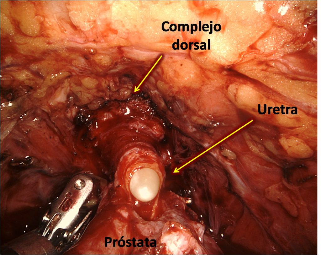 Figura 27. Visión de la uretra una vez seccionada la cara anterior, con la punta de la sonda vesical saliendo a través de ella.