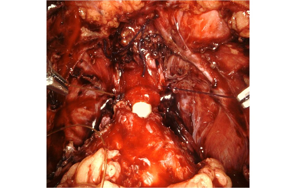 Figura 29. Anastomosis vesicouretral una vez completada la cara posterior, con un hilo de cada color y una sonda de Foley introduciéndose en la vejiga