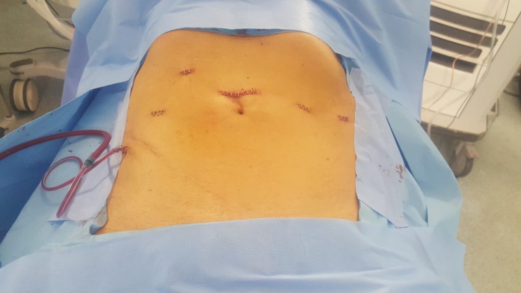 Figura 31. Visión del abdomen del paciente, una vez finalizada la cirugía, con un drenaje saliendo a través de la fosa ilíaca derecha (a través del trócar de 12 mm).