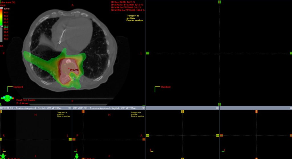 Figura 1. Imagen axial de planificación de SBRT vertebral. Línea verde = gross tumor volumen (GTV). Sombreado rojo indica el 100% de la dosis prescrita, sombreado verde 50% de la dosis.