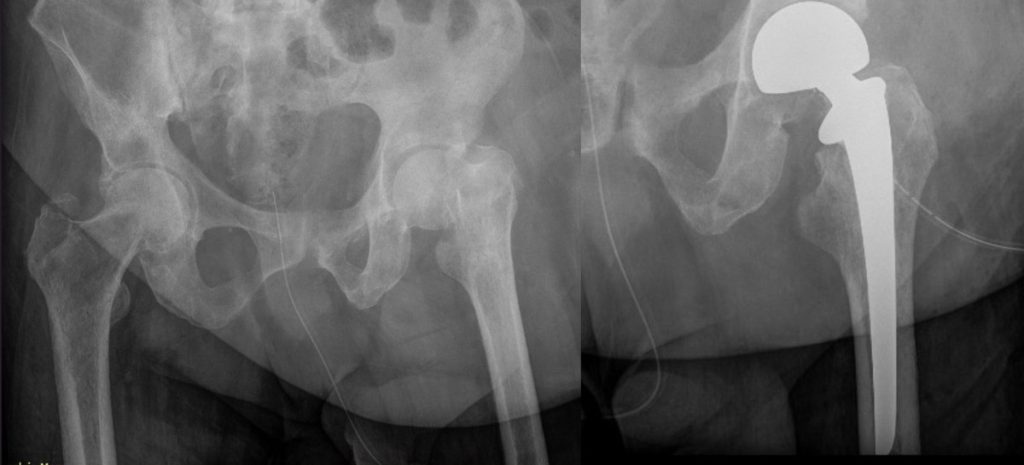 Figura 6. Paciente con múltiples metástasis en pelvis. Fractura patológica de fémur izquierdo. Reconstrucción con artroplastia parcial cementada.