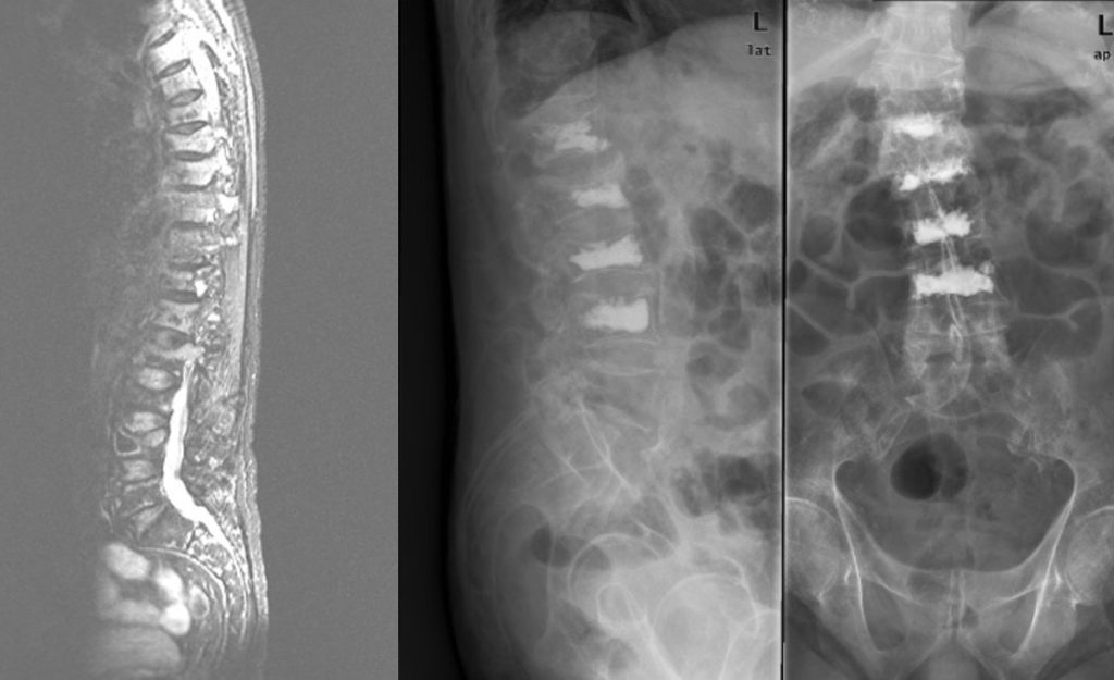 Figura 8. Imagen de resonancia magnética de fracturas vertebrales lumbares múltiples (izquierda). Se realizó cifoplastia multinivel en L1, L2, L3, L4 (control radiográfico proyección lateral en imagen central y anteroposterior imagen derecha).